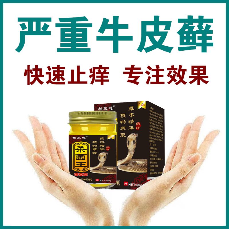 【杀菌王牛皮癣皮肤问题强效膏】50g真菌感染全身瘙痒顽顾型癣痒 - 图1