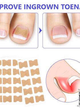 Breathable Self-Adhesive Elastic Toenail Correction Patch