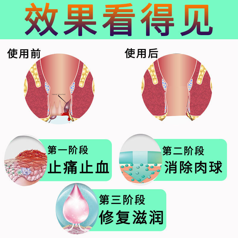 云南本草痔疮膏痔根断痔疮去肉球消肉球男女性凝胶神器药膏正品-图1