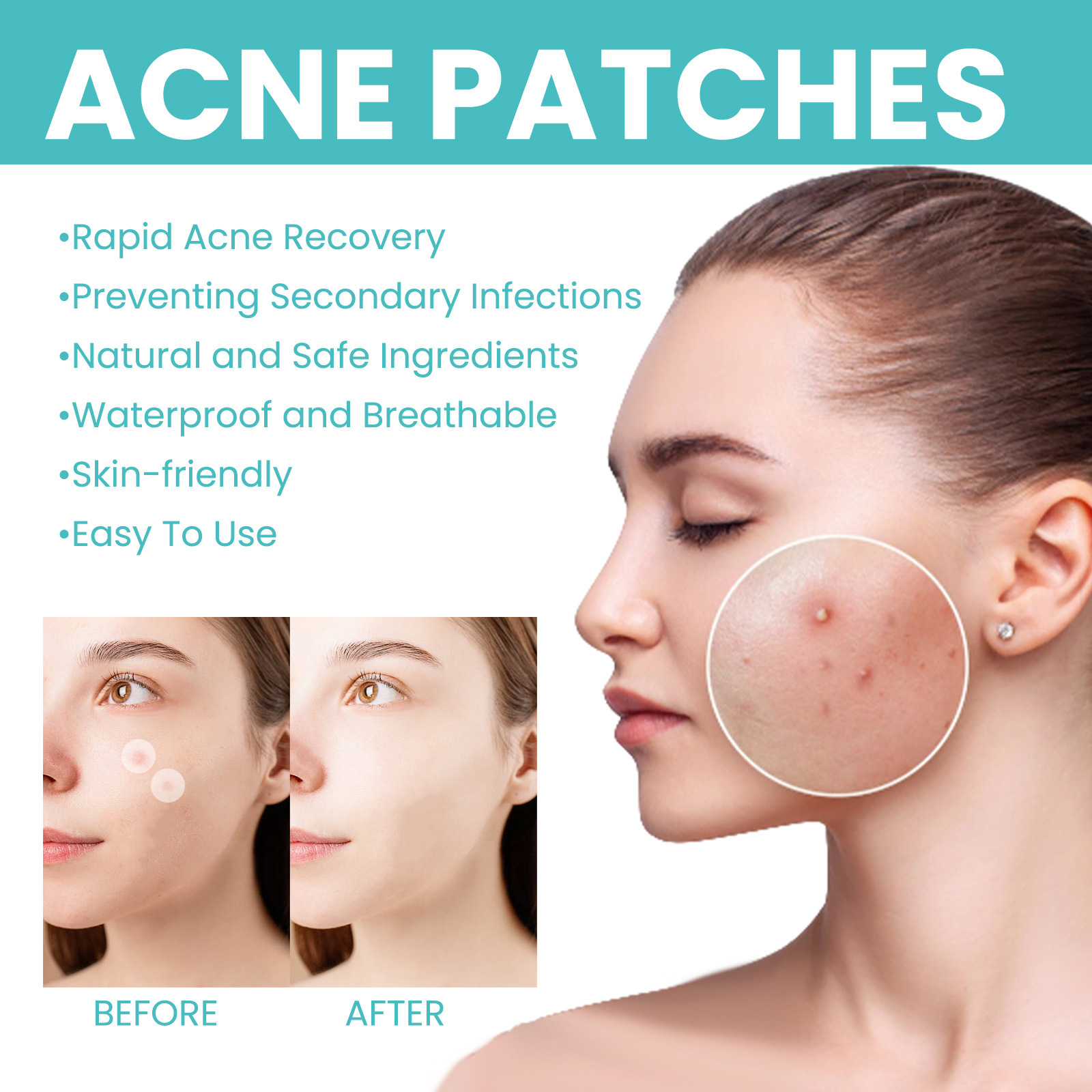 West & Month Acne Patch For Repairing Acne And Acne - 图2