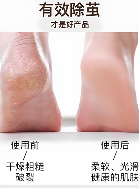 刮脚后跟磨脚皮神器刮脚死皮神器