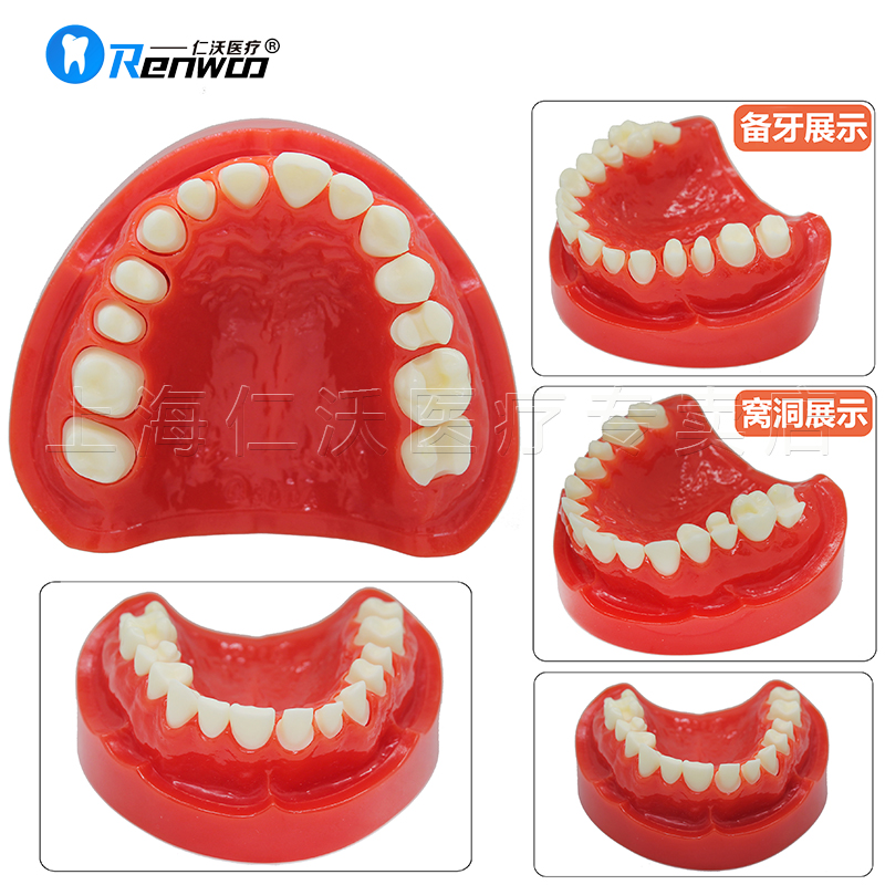 牙科模型 活动牙模型 吸附性义齿 种植杆卡 口腔牙模型 全口假牙 - 图0