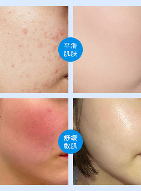 柏泉舒缓修护敏感肌肤冻干粉套装