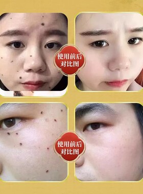 点痣药水药膏无痕正品脸部祛痣去痦子去痣去黑痣不留疤专用旗舰店