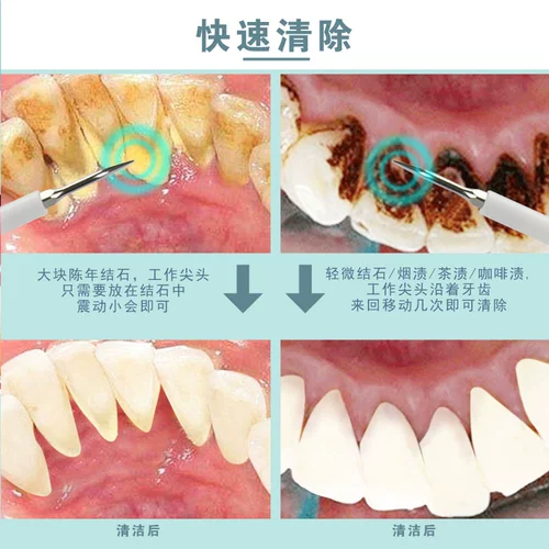 AI Man Ultrasonic Cleanser Home Cant Stone Удаление Чистое зуб грязь Daintication Dental Parke Artfact