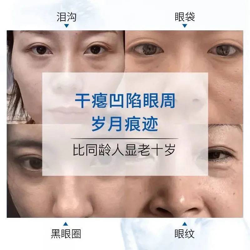 泪沟去除神器改善眼部凹陷填充修复跟泪沟说拜拜祛眼袋提拉遮瑕贴_虎窝淘