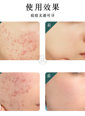 赛因诗婷豆仙优去痘霜淡化痘印