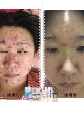 祛痘痘印粉刺嫩肤提亮
