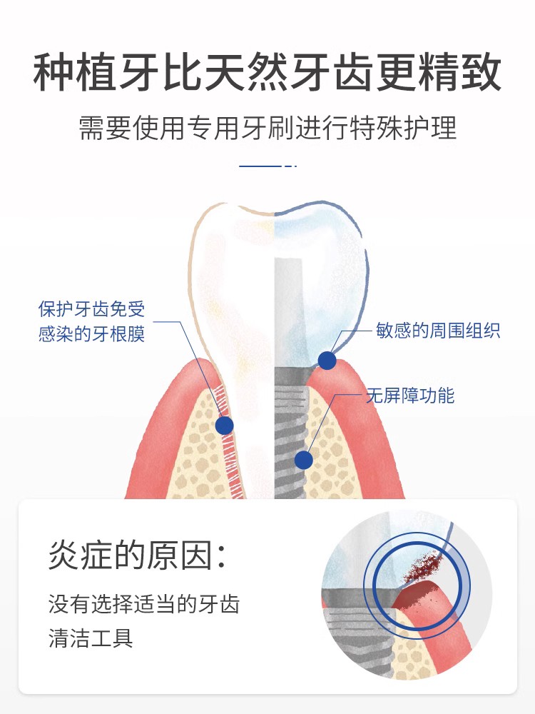 日本OralCare种植牙骨钉专用牙刷支抗钉拔牙单束超软毛清洁术后