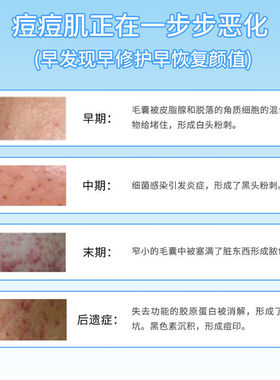 花恩诗祛痘膏中药淡印膏闭口粉刺