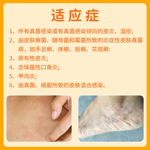正品】舒夫林曲安奈德益康唑乳膏30g 皮炎湿疹手足癣股癣甲沟炎 - 图0