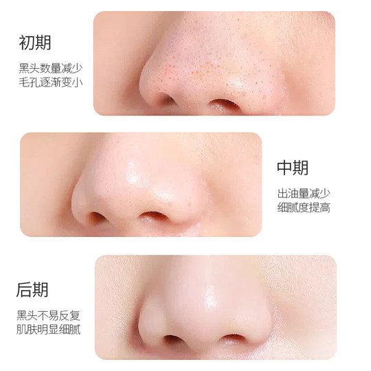 Parche para la nariz removedor de espinillas Tong Yan Ji