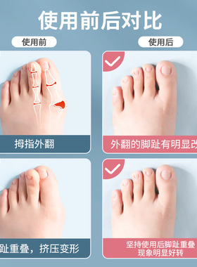 脚趾分趾器女款拇外翻可穿鞋防磨