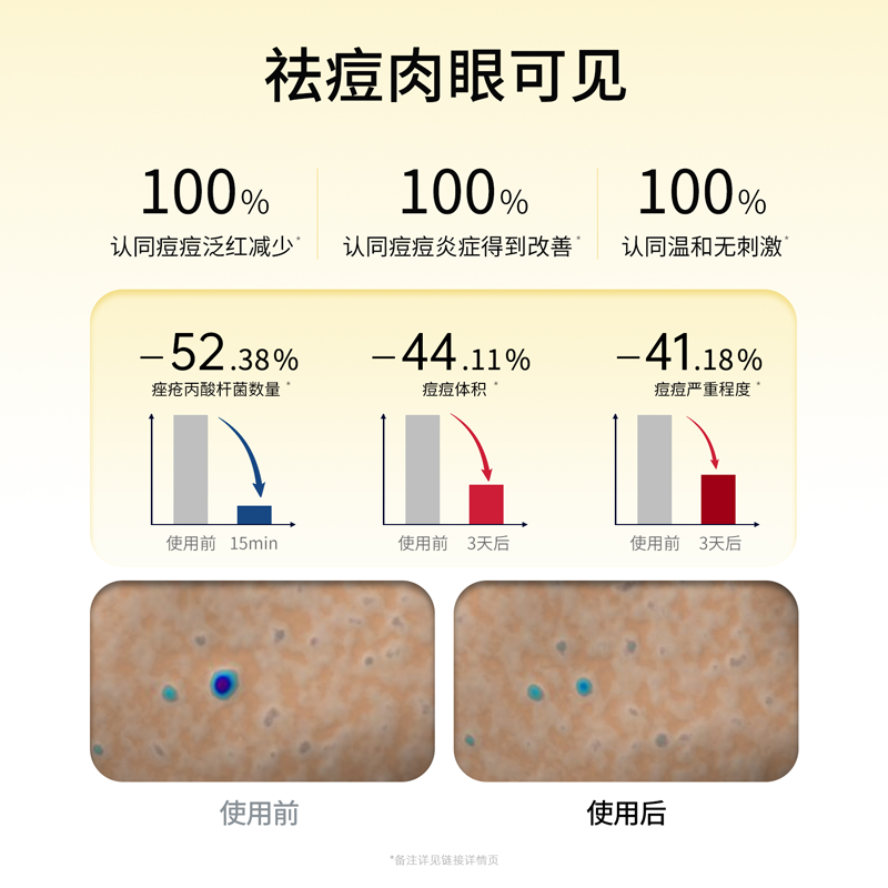 JOVS骄予时小纽扣电子祛痘贴痘痘贴LED光疗红光修护祛痘印抗菌