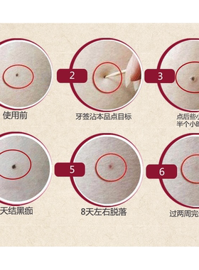 无痕斑点痣水脸部雀斑黑痣