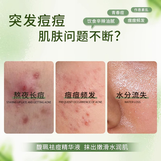 Fupei anti-acne essence fades acne, improves dry acne-prone skin, moisturizes and moisturizes Fupei official product