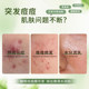 Fupei anti-acne essence fades acne, improves dry acne-prone skin, moisturizes and moisturizes Fupei official product