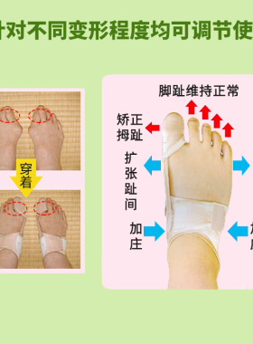 大脚骨分指透气可调节外翻矫正器