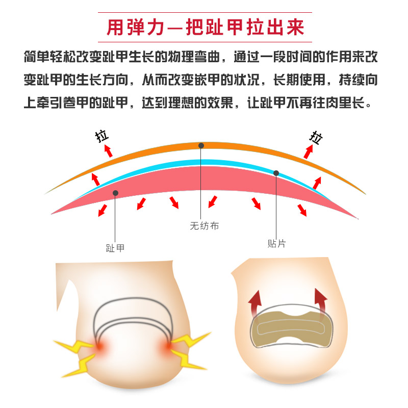 正甲贴甲沟嵌甲矫正器炎脚沟脚趾趾甲贴片纠正指甲长肉里神器套装 - 图2