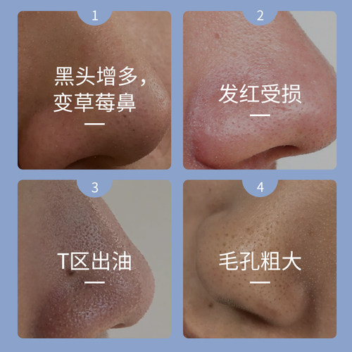 【9.20到期】瓷肌去黑头导出液祛黑头深度清洁肌肤改善洁净毛孔 - 图2