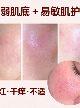 脂溢肌玫瑰脸激素脸修护肌肤表层