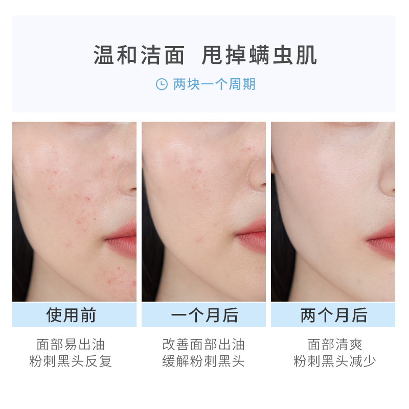 稚优泉化妆品旗舰店稚优泉正品茶树精油除螨皂洗脸香皂男女面背部全身深层清洁去螨虫1