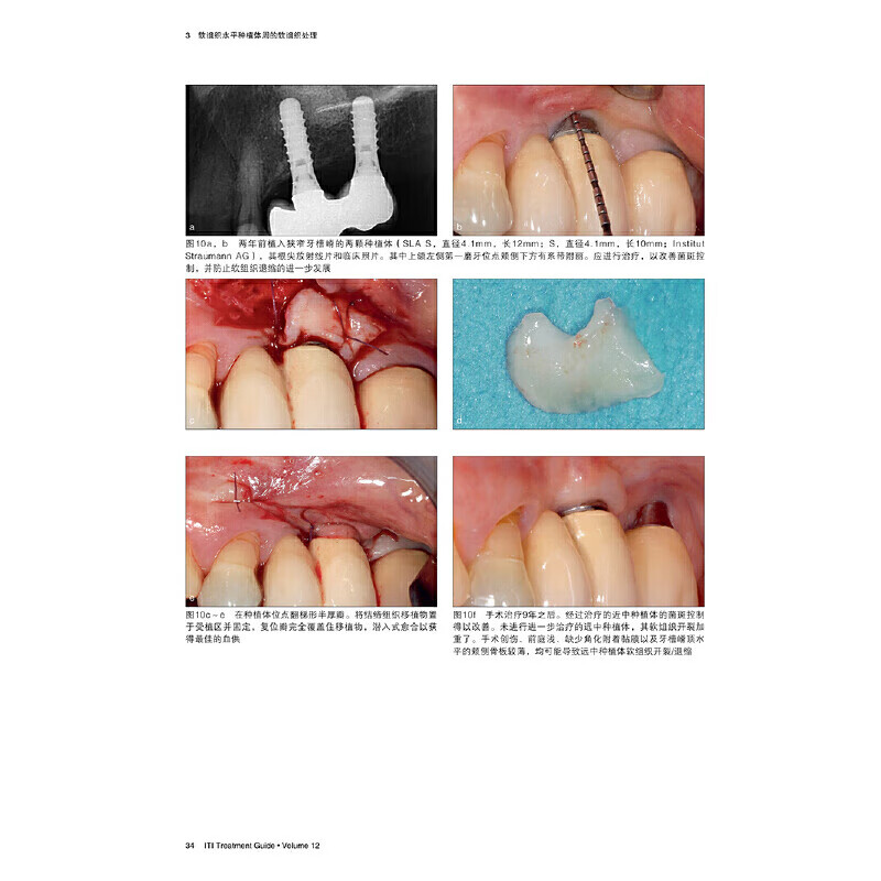 种植体周软组织整合与处理国际口腔种植学会ITI口腔种植临床指南第十二卷宿玉成译软组织增量移植辽宁科学技术出版社-图0