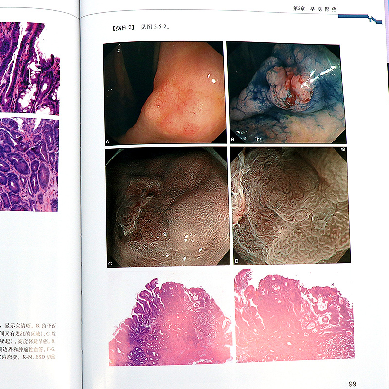 消化道早期癌内镜诊断技巧图谱盛剑秋金木兰金鹏NBI内镜新技术内镜胃镜操作手法技巧内镜诊断图谱胃镜诊断图谱消化道内镜诊断秘籍 - 图0