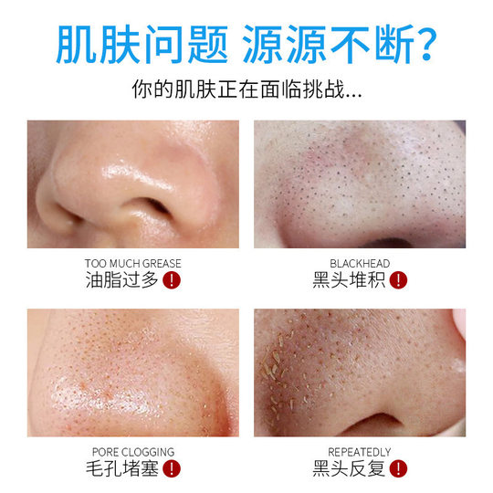 Blackhead Exporting Liquid-Refundable