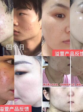 溢萱幼肌膏辅助淡化痘印粉刺调理皮肤 改善黑头闭口泥面膜嫩肤膏