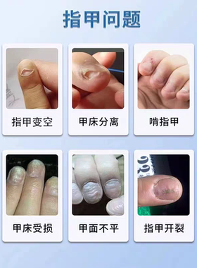 指甲开裂修复液软薄断裂竖纹分层甲床分离甲肉空甲修中间复盖凹凸