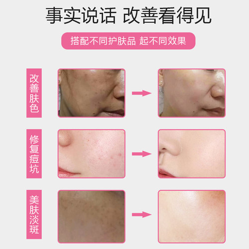 秋水堂纳米电动微针水光mts痘坑印祛斑淡斑家用美容院笔导入仪器 - 图1