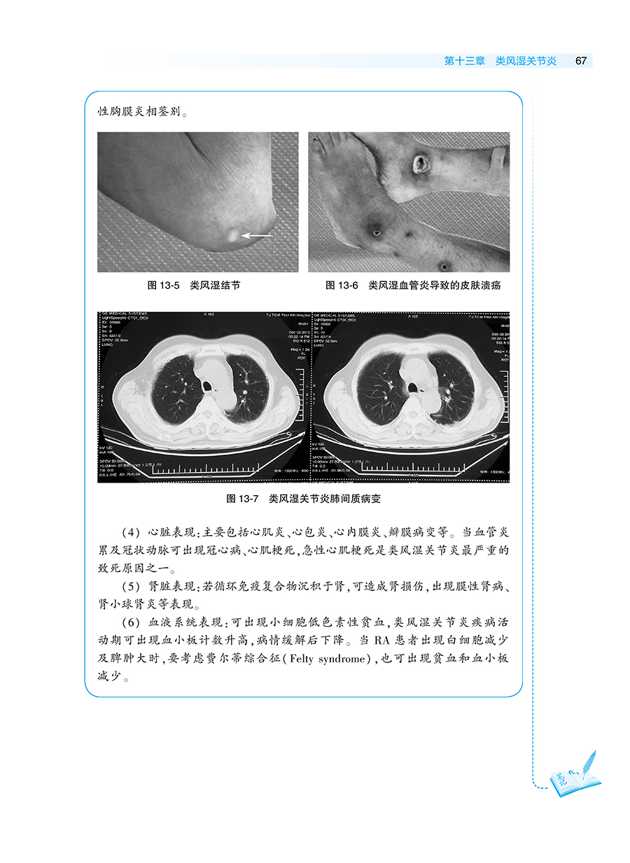 中医内科学风湿分册刘维茅建春国家健康委员会十三五规划教材全国中医住院医师规范化培训教材人民卫生出版社9787117341301-图2