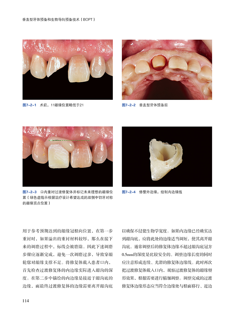 垂直型牙体预备和生物导向预备技术BOPT 刘峰等编 口腔临床牙体预备技术详细操作步骤 病例精选 辽宁科学技术出版社9787559132123 - 图2