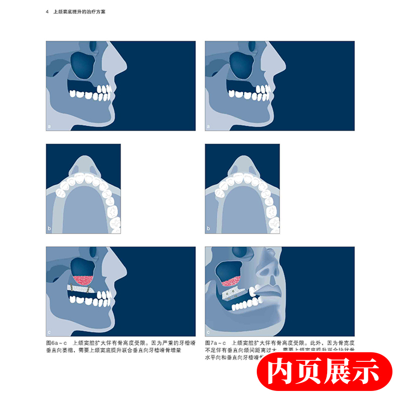 上颌窦底提升的临床程序国际口腔种植学会 ITI口腔种植临床指南第五卷5卷宿玉成教授主译辽宁科学技术出版社-图3