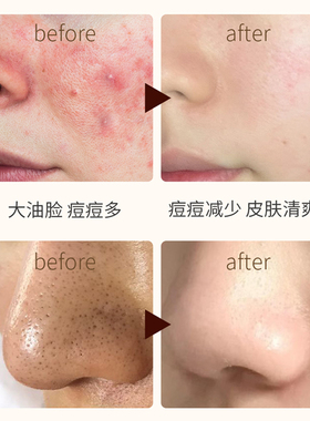 隆力奇多效硫磺净澈控油洁颜泥