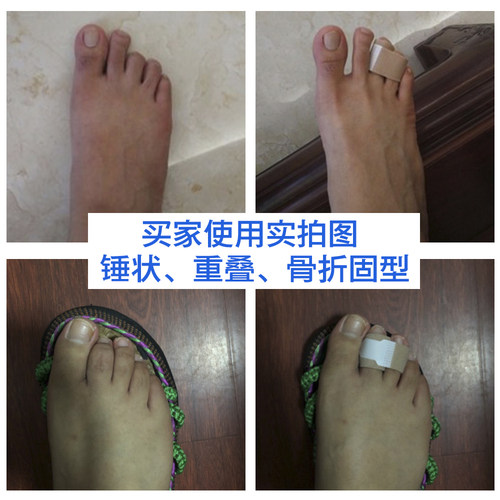 脚趾弯曲矫正器锤状趾爪槌状趾二三脚指变形重叠纠正拇趾成人儿童 - 图0
