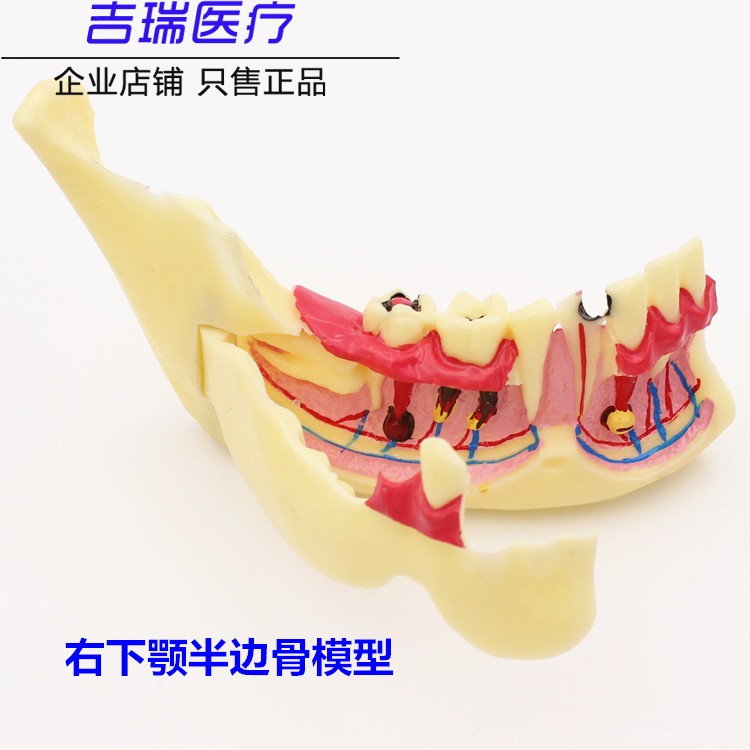 牙齿模型口腔教学正畸种植修复模型可拆卸假牙备牙模型雕石膏牙科 - 图2