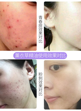 白术薰衣草粉刺修复疤痕精华液