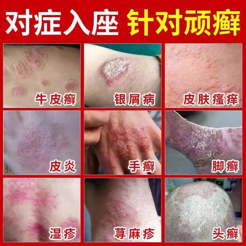 股癣大腿内侧囊瘙痒湿疹肛门屁股阴私处藓癬真菌感染男女专用 - 图1