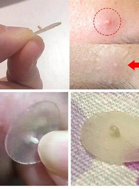 Acne Pimple Patch Stickers Treatment Pimple Remover 痘痘贴