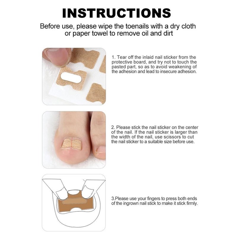 Ingrown Toenail Sticker Nail-Corrector Foot-Care Glue - 图2