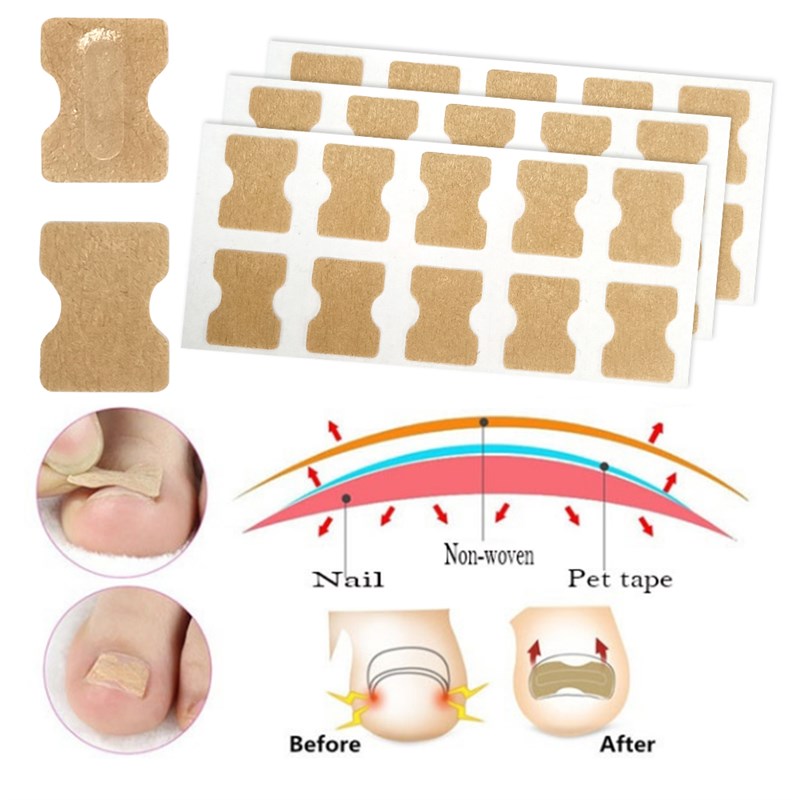 新品Ifory 20Pcs Ingrown Toenail Correction Pedicure Foot Ort - 图3