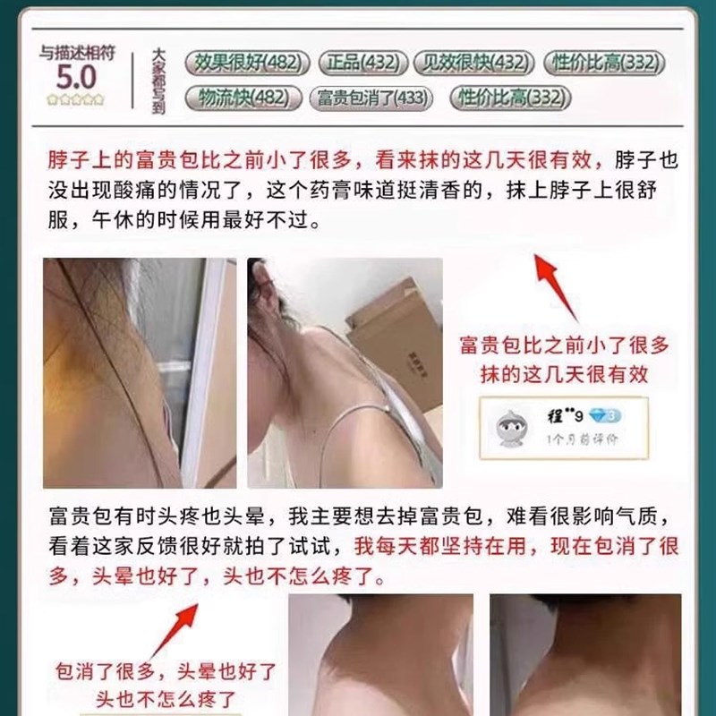 去除富贵包消除贴正品神器矫正颈椎驼背快速疏通肩颈部专用按摩器 - 图0