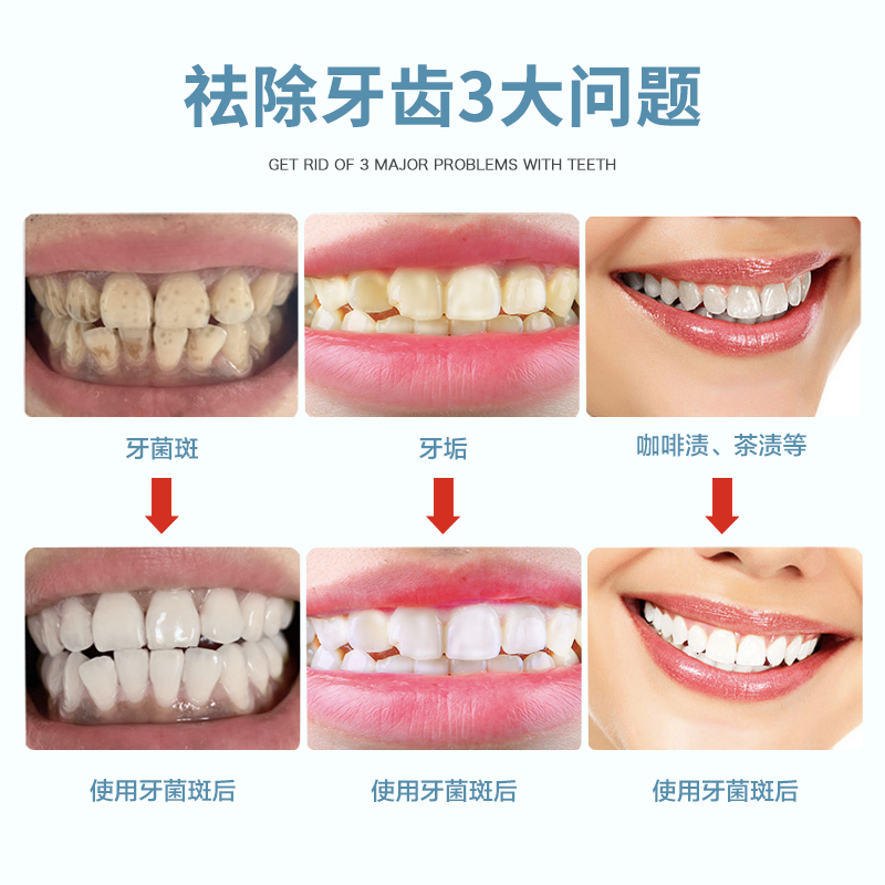 洗牙齿污垢除牙石洗牙神器洁牙去牙渍牙垢牙菌斑祛除牙斑净的药水-图1