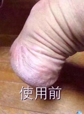 意大利drscoll爽健脚裂膏