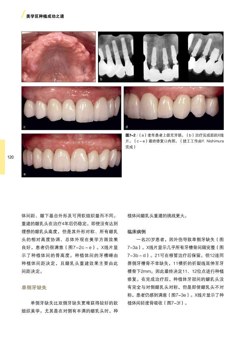 美学区种植成功之道汤春波主编美学区种植的手术设计美学分析外科操作软硬组织增量二期手术方式辽宁科学技术出版社 9787559123305