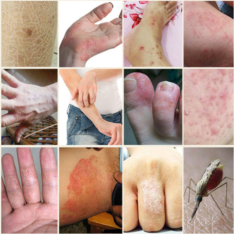 千若轩癣达净皮肤瘙痒止痒水泡脱皮抑菌藓身上痒外用软膏大腿内侧