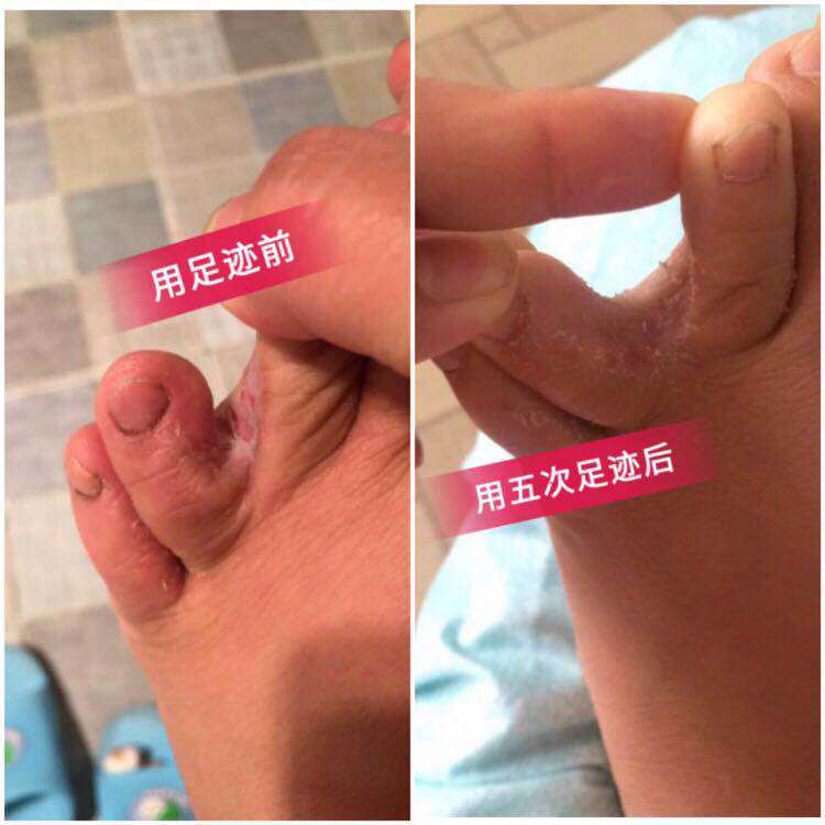 欧果足记清爽抑菌液足迹脱皮50喷剂 微微盈超市 服务大家足霜