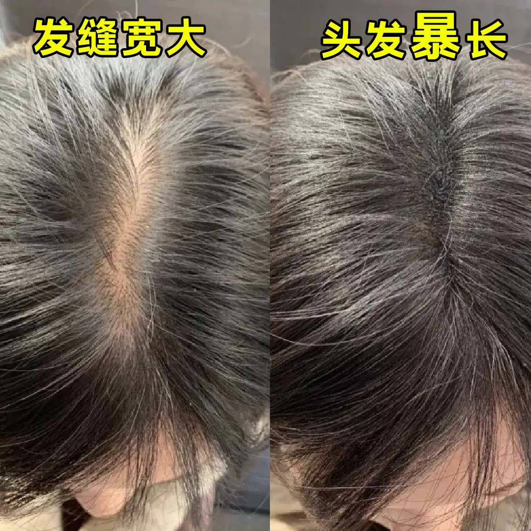 【618狂欢】生发液育发液防脱增发密发固发发际线快速增长营养液_虎窝淘